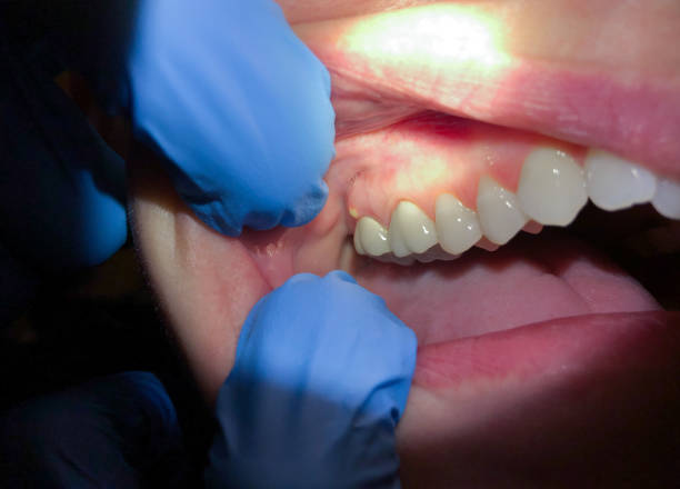 Best Emergency Dental Care for Broken or Chipped Teeth in Santa Fe, NM