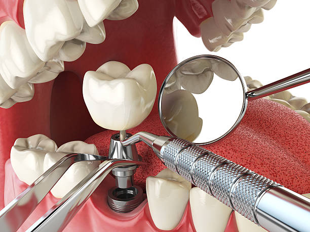 Best Emergency Treatment for Dental Infections or Abscesses in Santa Fe, NM